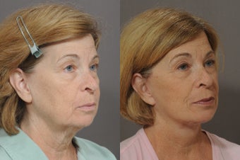 Lower Face and Neck Lift after 850299