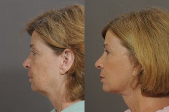 Lower Face and Neck Lift 850299