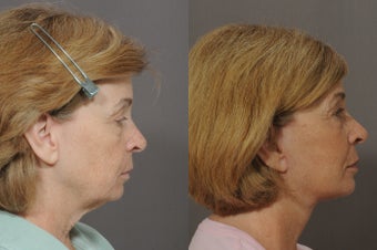 Lower Face and Neck Lift 850299