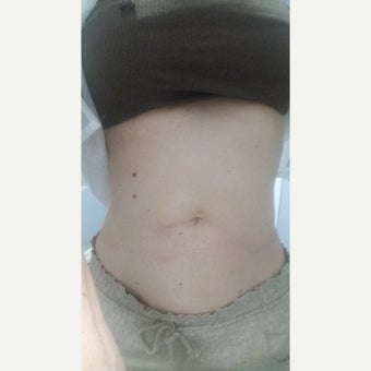 35-44 year old woman treated with Exilis Elite for unwanted inches in the waist. after 3094594