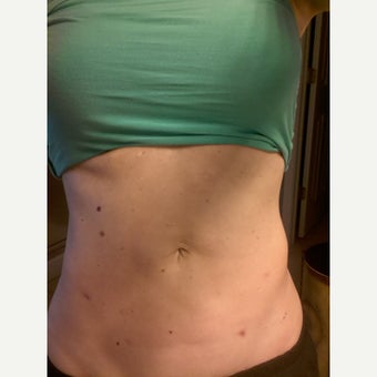 35-44 year old woman treated with Exilis Elite for unwanted inches in the waist. before 3094594