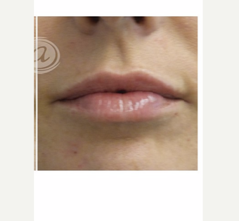 55-64 year old woman treated with Volbella after 3783695