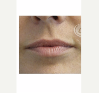 55-64 year old woman treated with Volbella before 3783695