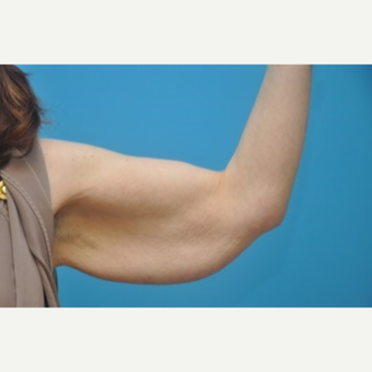 45-54 year old woman treated with Arm Lift/Brachioplasty before 3076408