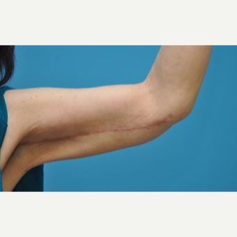 45-54 year old woman treated with Arm Lift/Brachioplasty after 3076408