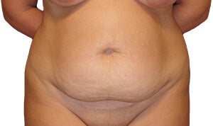 34 year old woman treated with Tummy Tuck before 3174732