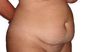 34 year old woman treated with Tummy Tuck 3174732