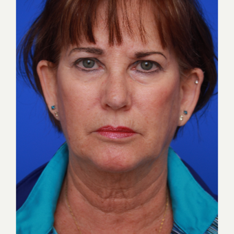 63- year old woman treated with Facelift before 3787924
