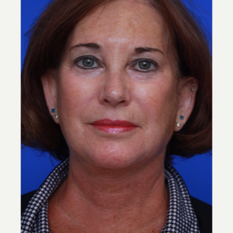 63- year old woman treated with Facelift after 3787924