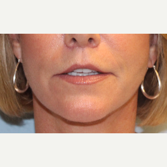 55-64 year old woman treated with Lip Lift after 3570822