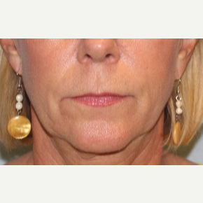 55-64 year old woman treated with Lip Lift before 3570822