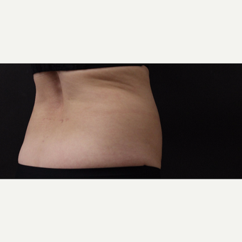 55 year old woman treated with CoolSculpting before 3220725