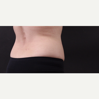 55 year old woman treated with CoolSculpting after 3220725