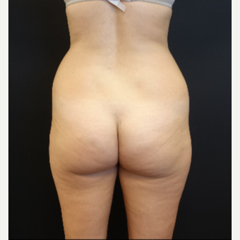 25-34 year old woman treated with Butt Implants before 3629815