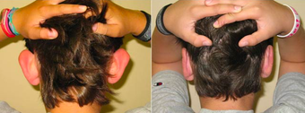 Ear Surgery before 1012849