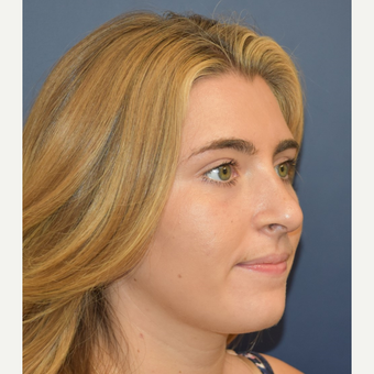 18-24 year old woman treated with Nose Surgery after 3251910