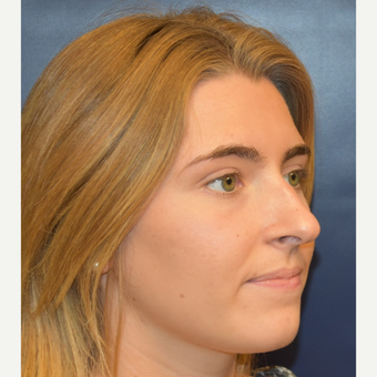 18-24 year old woman treated with Nose Surgery before 3251910