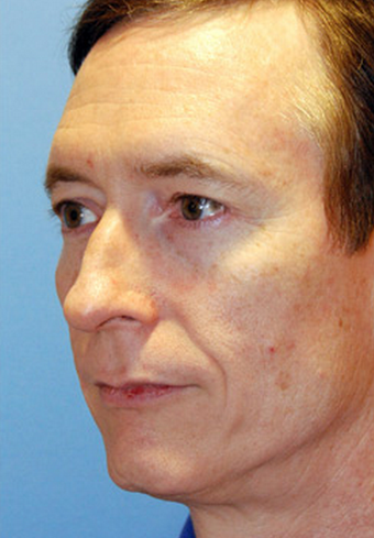 Facial Feminization: Rhinoplasty, Brow lift, Brow Bone Reduction, Lip Augmentation, Hairline Lowering before 1423798