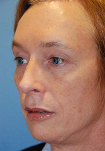 Facial Feminization: Rhinoplasty, Brow lift, Brow Bone Reduction, Lip Augmentation, Hairline Lowering after 1423798