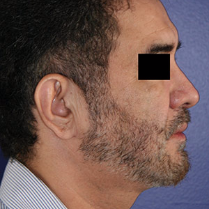 46 year old man treated with Chin Implant after 3710610