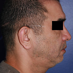 46 year old man treated with Chin Implant before 3710610