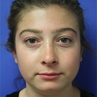 18-24 year old woman treated with Rhinoplasty after 3400347
