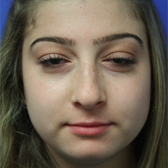 18-24 year old woman treated with Rhinoplasty before 3400347