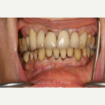 45-54 year old woman treated with All-on-4 Dental Implants before 3258937