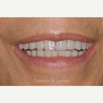 45-54 year old woman treated with All-on-4 Dental Implants after 3258937