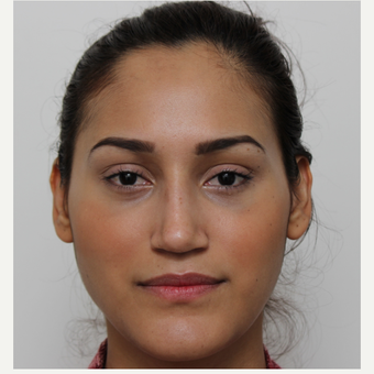 25-34 year old woman treated with Rhinoplasty after 3372311