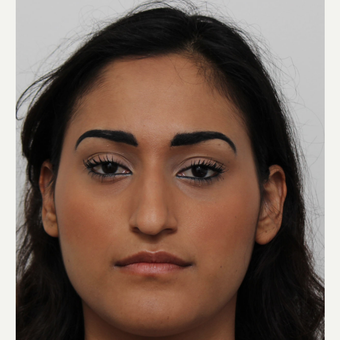 25-34 year old woman treated with Rhinoplasty before 3372311