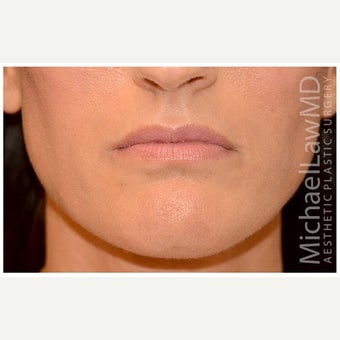35-44 year old woman treated with Cheek Augmentation after 1569172