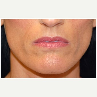 35-44 year old woman treated with Cheek Augmentation before 1569172