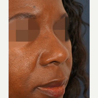 35-44 year old woman treated with Non Surgical Nose Job after 3244895