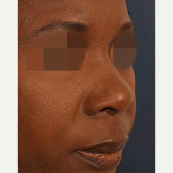 35-44 year old woman treated with Non Surgical Nose Job before 3244895