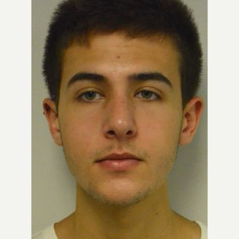 17 year old man treated with Nose Surgery after 3123001