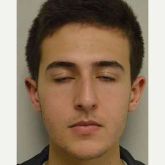 17 year old man treated with Nose Surgery before 3123001