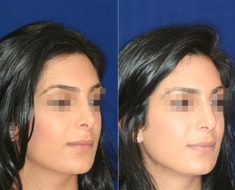 Nose Surgery before 1430784