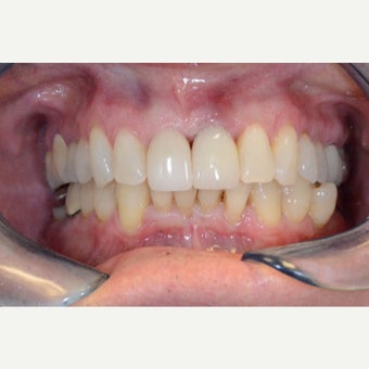 Dental Implant to replace broken front tooth after 2498054
