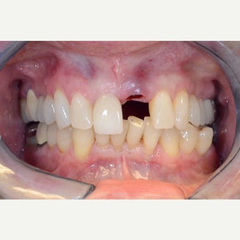 Dental Implant to replace broken front tooth before 2498054