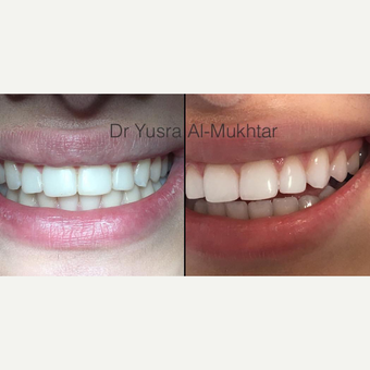 18-24 year old woman treated with Teeth Whitening before 3364352