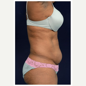 45-54 year old woman treated with Tummy Tuck before 3076177