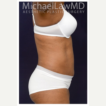 45-54 year old woman treated with Tummy Tuck after 3076177