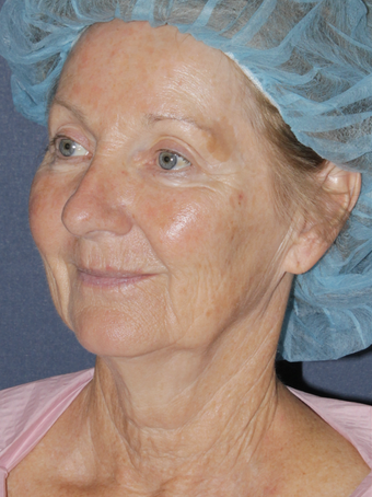 Fraxel Repair Face before 1064574