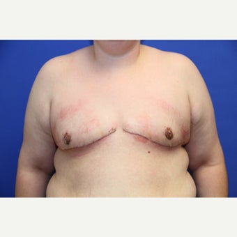 27 year old man treated with FTM Chest Masculinization Surgery after 1929741