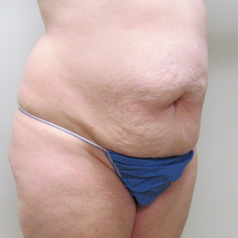 Liposuction for this 52 Year Old Woman before 3289246