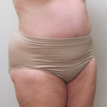 Liposuction for this 52 Year Old Woman after 3289246