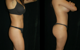 Brazilian Butt Lift after 1304519