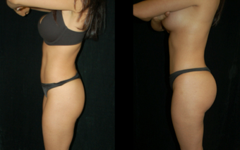 Brazilian Butt Lift before 1304519