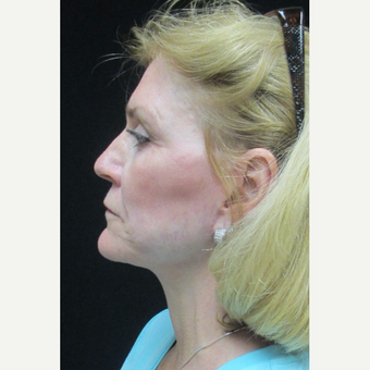 55-64 year old woman treated with Facelift after 3088493